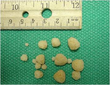 can you dissolve calcium oxalate kidney stones