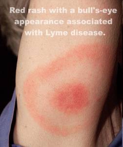 Lyme Disease