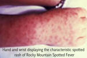 RMSF Skin Rash